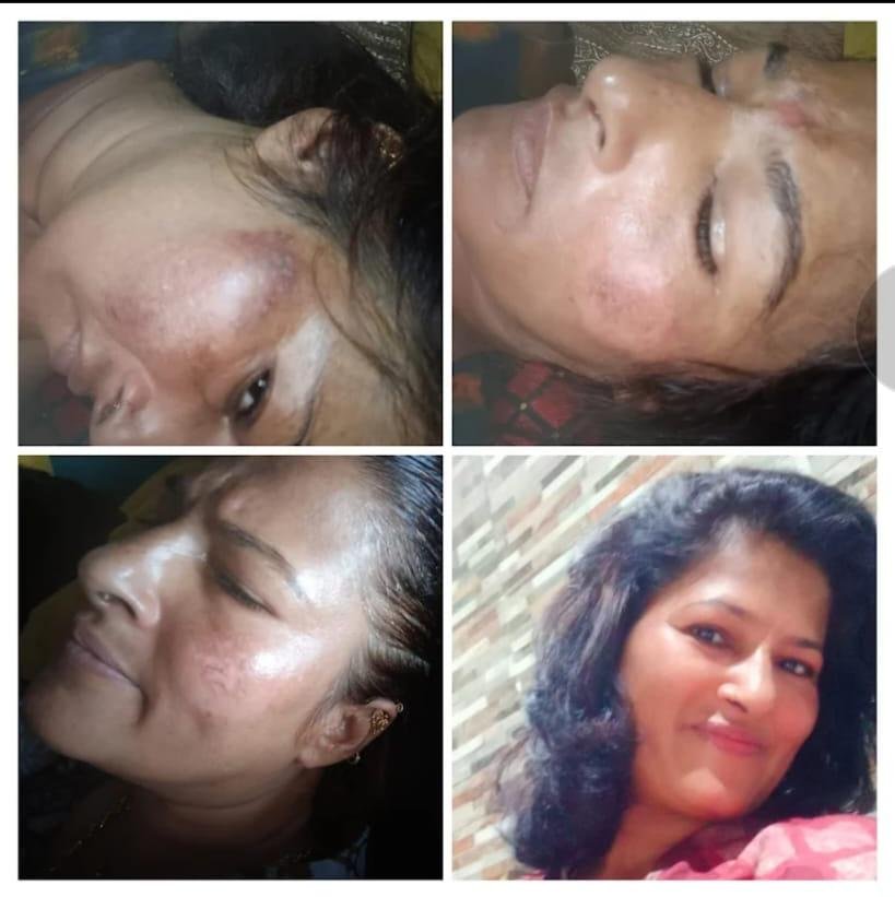 Melasma Treatment