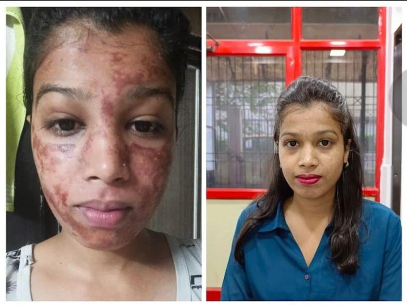 Skin Burning Treatment
