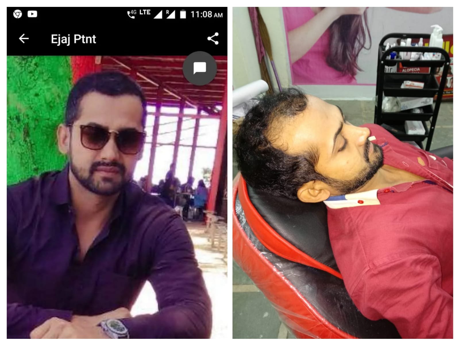 Male Pattern Of Alopecia Treatment